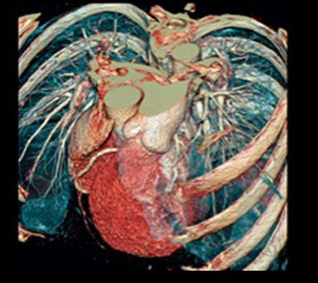 Coronary CT Angiography