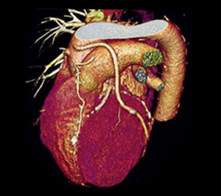 Cardiac CT Scan