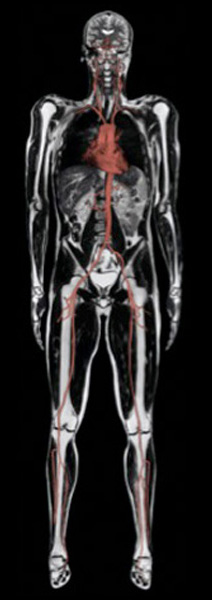 Whole Body MRI Scan